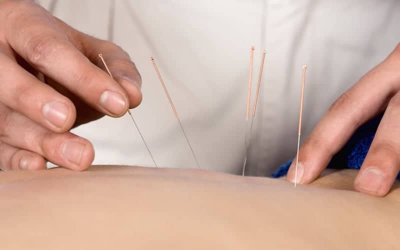 acupuncture for headaches and migraines
