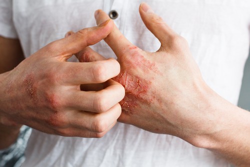 Woman scratching hands because of eczema